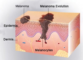 Evolution-melanoma